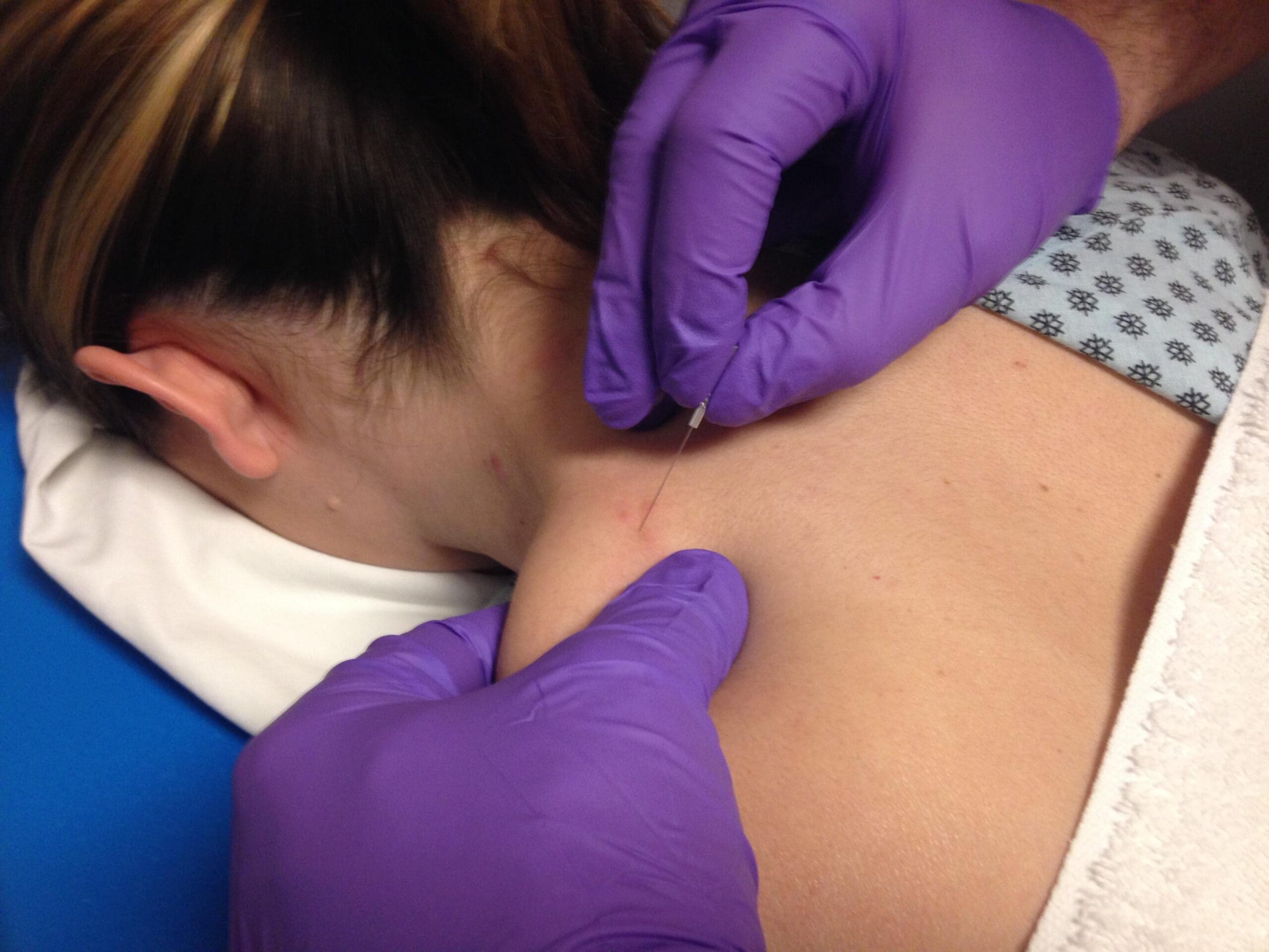 Dry Needling